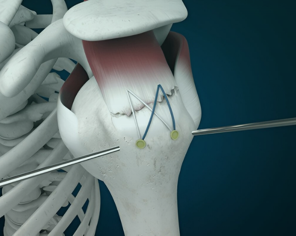 Rotator Cuff Repair